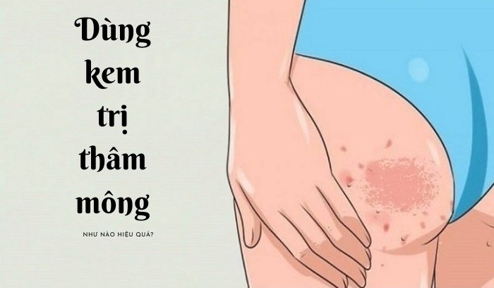 Tổng Quan Về Kem Trị Thâm Mông