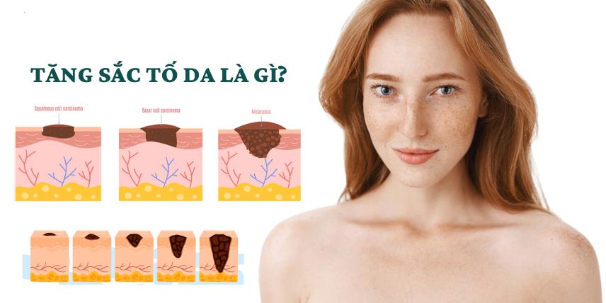 sắc tố da là gì? liệu đi spa có cải thiện được không?