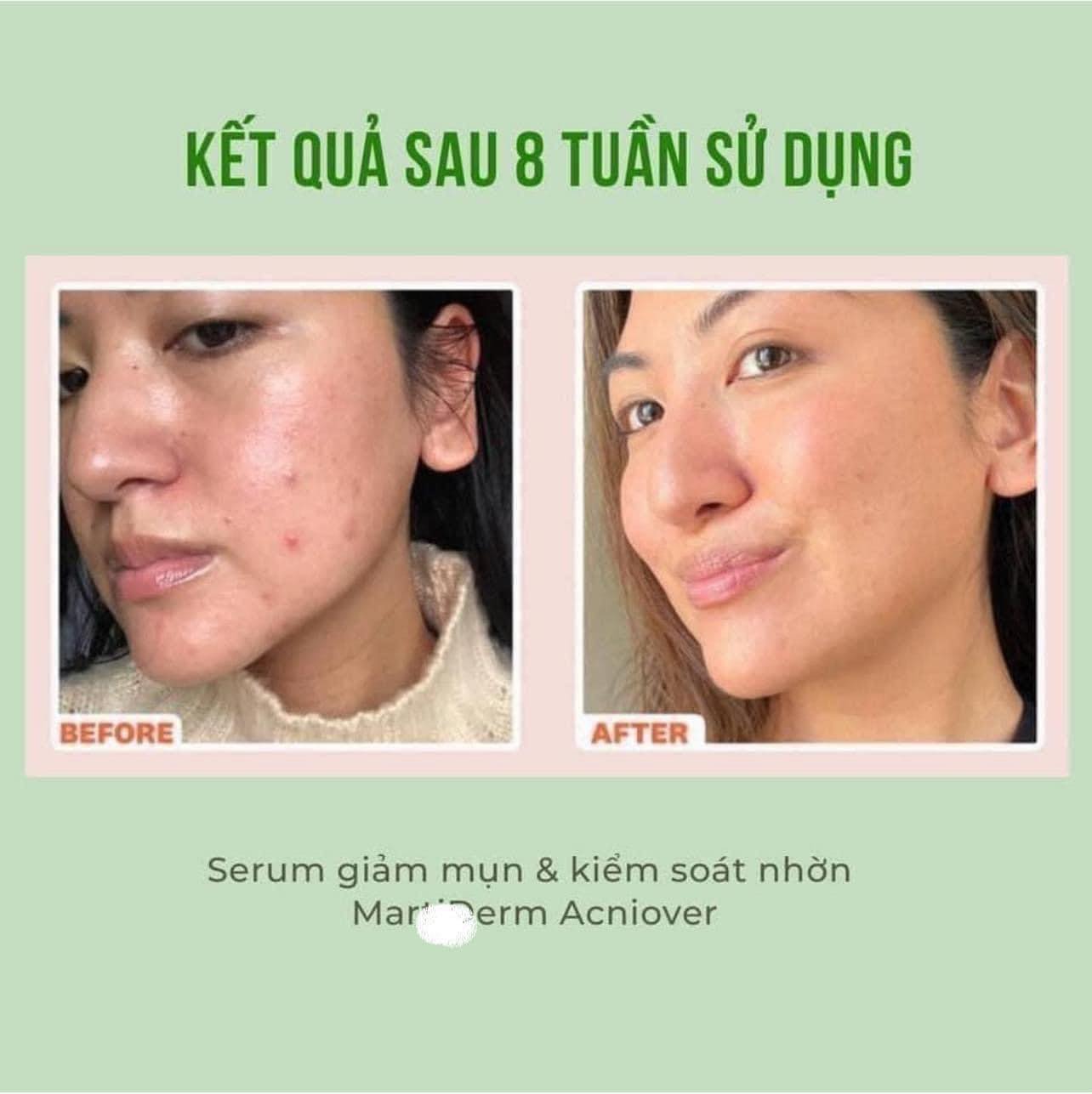 Tinh Chất Giảm Mụn & Kiểm Soát Nhờn Martiderm Acniover Serum 30mlTinh chất  giảm mụn & kiểm soát nhờn Martiderm Acniover Serum – annguy.beauty