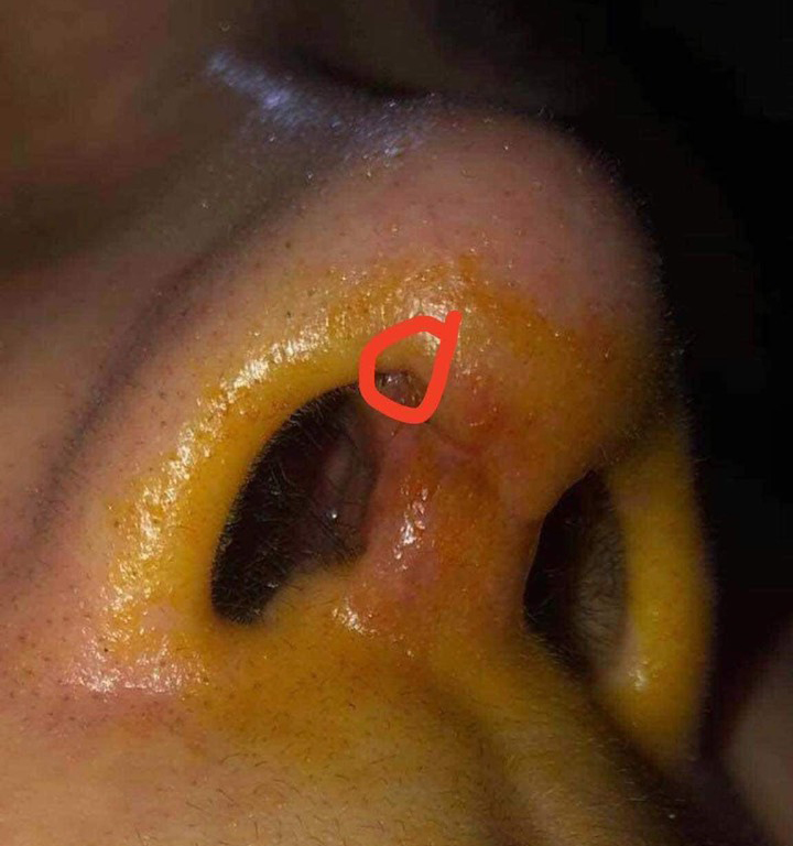 Đừng để 'tiền mất, tật mang' vì thẩm mỹ không an toàn- Ảnh 1. Biến chứng do nâng mũi cơ sở chui