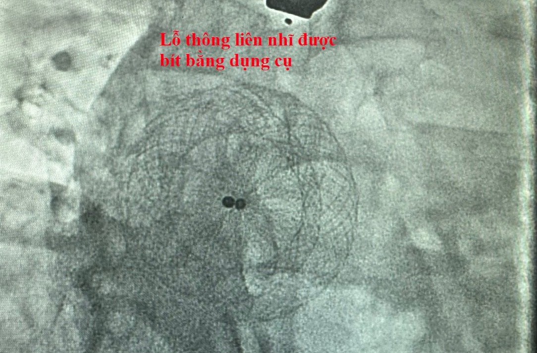 Can thiệp thành công 5 ca thông liên nhĩ thứ phát bằng dụng cụ qua da- Ảnh 2. Can thiệp thành công 5 ca thông liên nhĩ thứ phát bằng dụng cụ qua da- Ảnh 2.