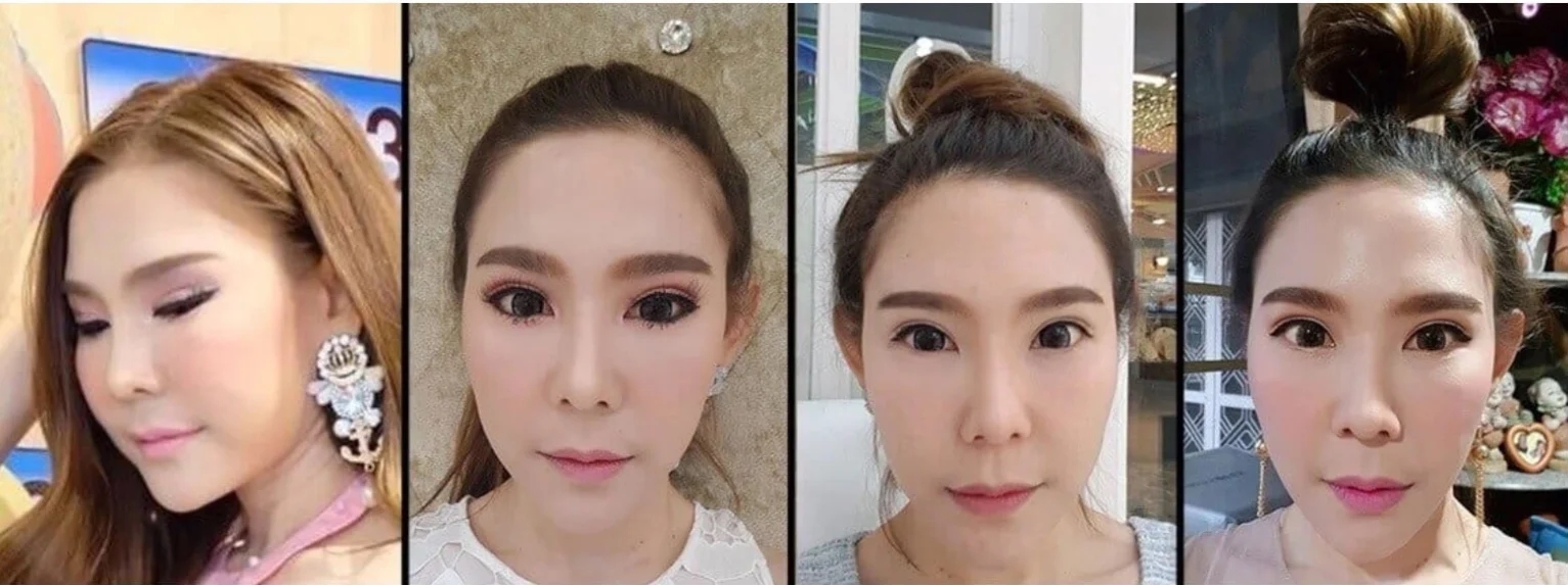 Fat burning injections with Meso Fat, how to take care of yourself