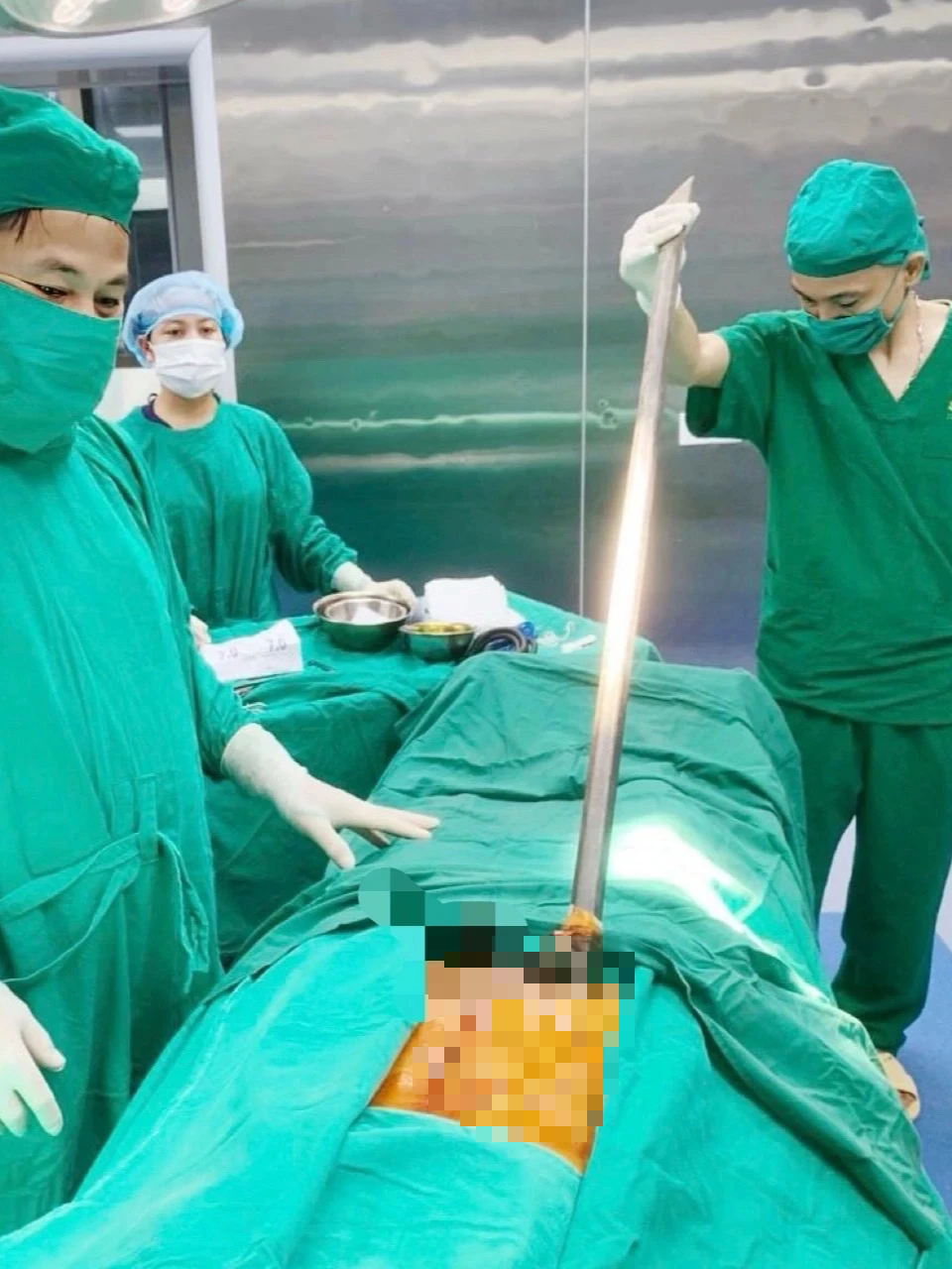 Phẫu thuật thành công cho bệnh nhân bị xà beng đâm xuyên bụng- Ảnh 1. Thanh xà beng đâm vào bụng bệnh nhân B.