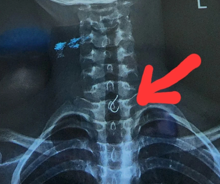 Bà Rịa-Vũng Tàu: Bé trai 13 tuổi nuốt lưỡi câu vào thực quản- Ảnh 1. Bà Rịa-Vũng Tàu: Bé trai 13 tuổi nuốt lưỡi câu vào thực quản- Ảnh 1.