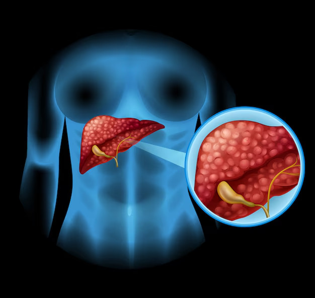 Gan nhiễm mỡ nếu không được điều trị có thể dẫn đến viêm gan, xơ gan và thậm chí là ung thư gan