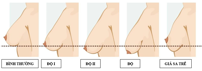 Sẹo treo ngực sa trễ, cơn ác mộng của phụ nữ- Ảnh 2.