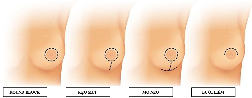 Sẹo treo ngực sa trễ, cơn ác mộng của phụ nữ- Ảnh 3.