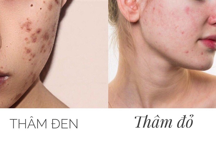 Vết thâm mụn mãi không hết, phải làm sao?