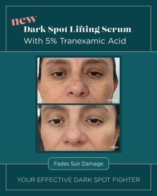 Review serum trị nám VI Derm Dark Spot Lifting Serum có hiệu quả tận gốc không?- Ảnh 8.