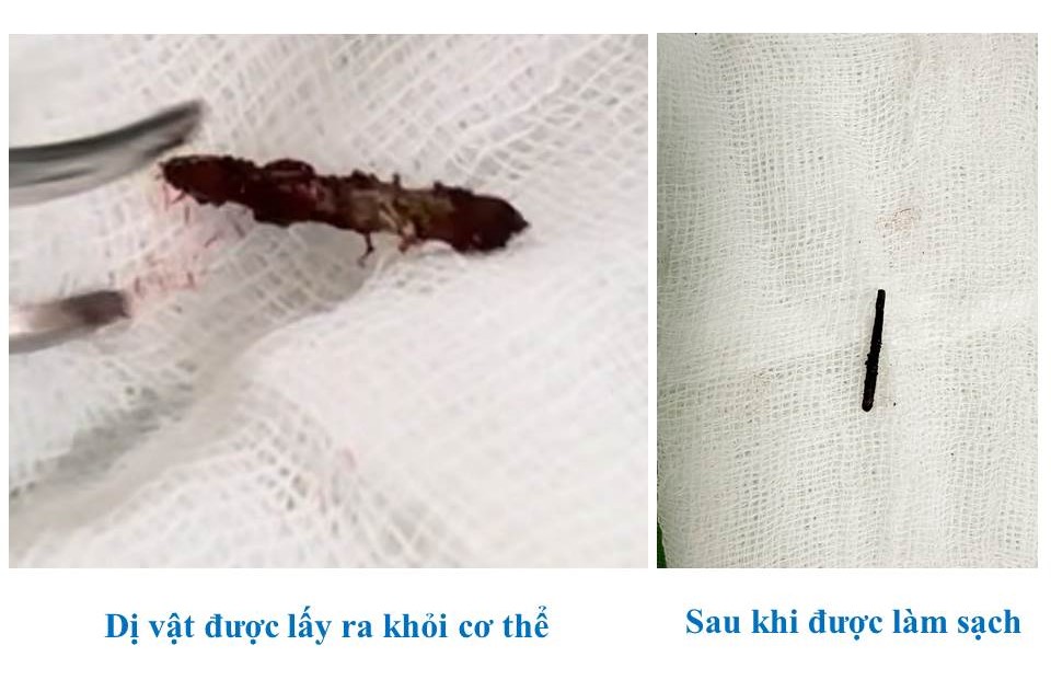 Khám sức khỏe, phát hiện chiếc đinh rỉ trong cổ bệnh nhân- Ảnh 1. Khám sức khỏe, phát hiện chiếc đinh rỉ trong cổ bệnh nhân- Ảnh 1.