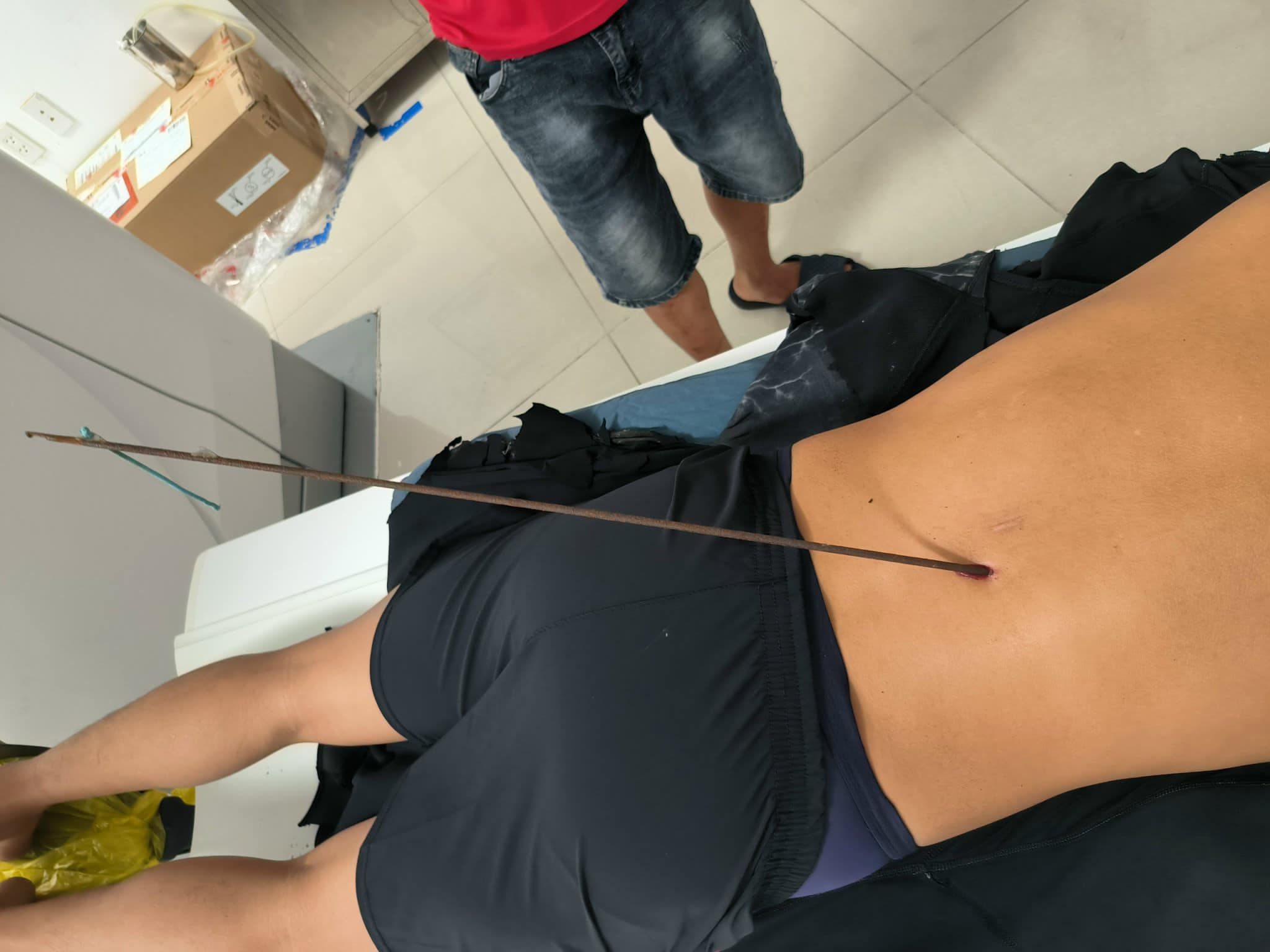 Cứu sống bệnh nhân bị mũi tên bắn cá găm vào lưng, thủng phổi- Ảnh 1. Cứu sống bệnh nhân bị mũi tên bắn cá găm vào lưng, thủng phổi- Ảnh 1.