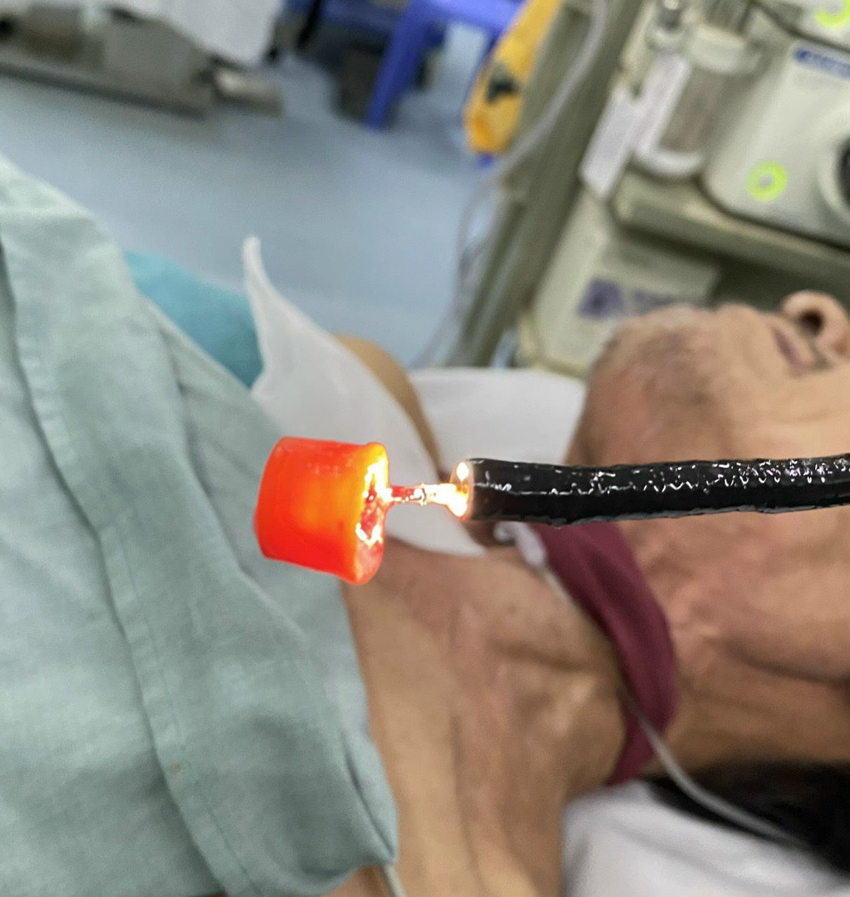 Gắp nắp chai dầu gió rơi vào lỗ mở khí quản bệnh nhân- Ảnh 1. Gắp nắp chai dầu gió rơi vào lỗ mở khí quản bệnh nhân- Ảnh 1.