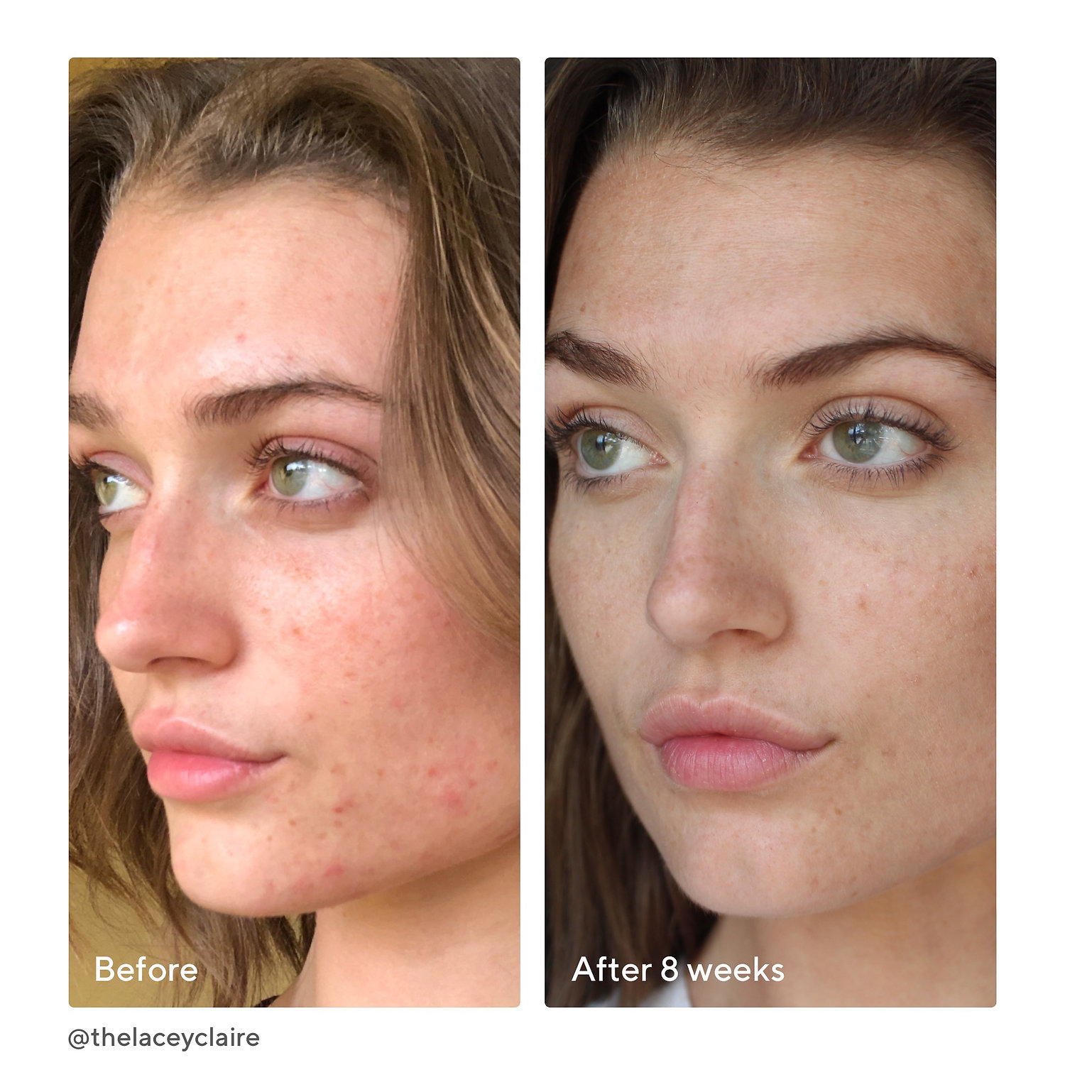 InvisiScar Post-Acne Resurfacing Treatment