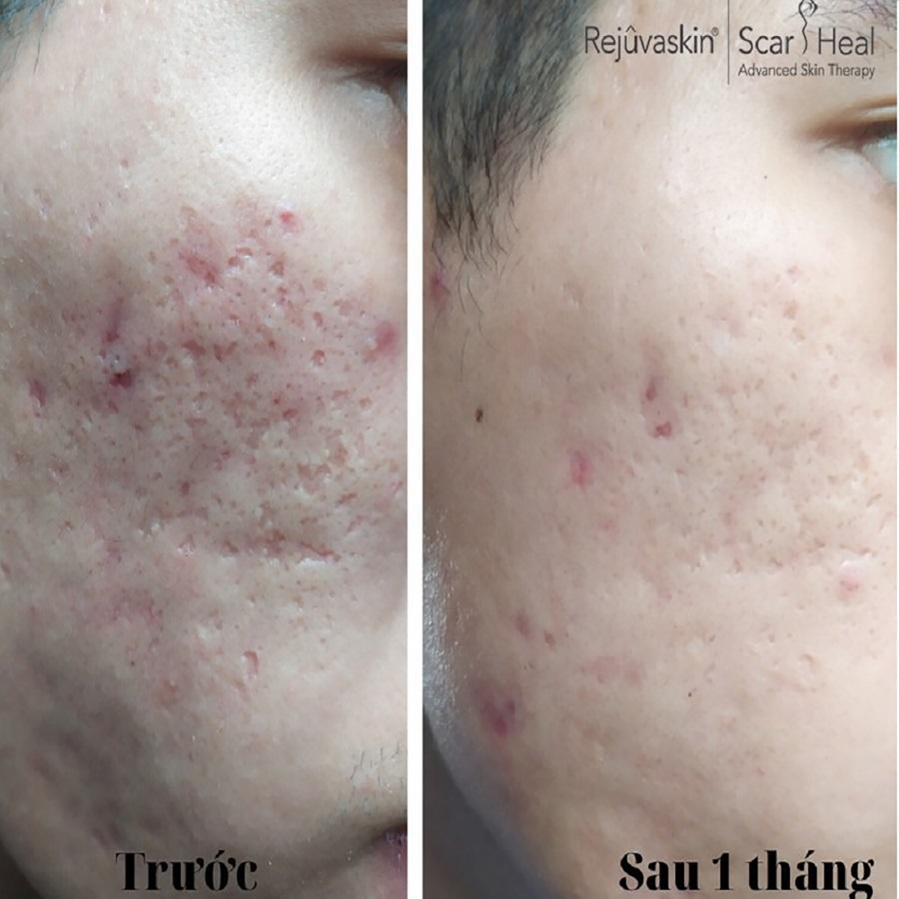 Top 10 kem trị sẹo rỗ, sẹo lõm hiệu quả tại nhà với cả sẹo lâu năm