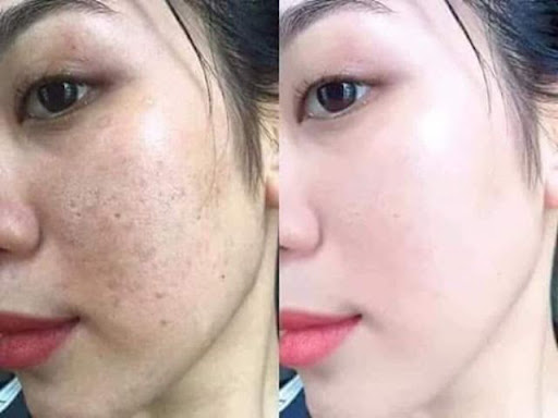 Sự thay đổi của làn da trước và sau khi sử dụng Kem làm mờ nám tàn nhang thể nặng White Doctors Melasma Pro