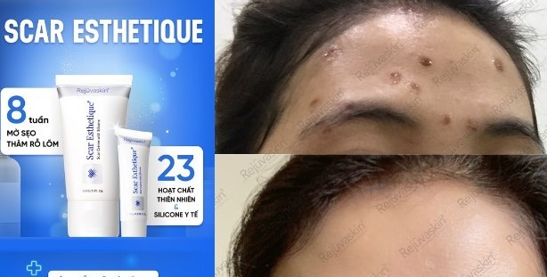 Mẹo chăm sóc da thủy đậu ít để lại sẹo- Ảnh 3.