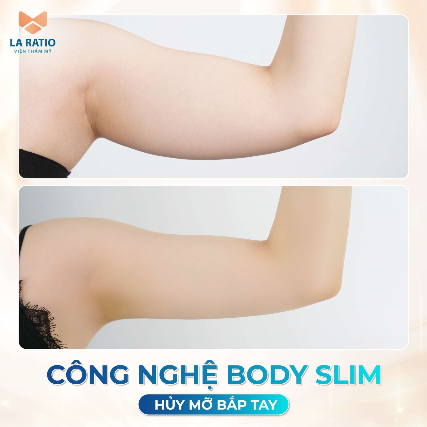 Bí quyết giảm béo nhanh chóng, an toàn với công nghệ Body Slim tại La Ratio- Ảnh 3.