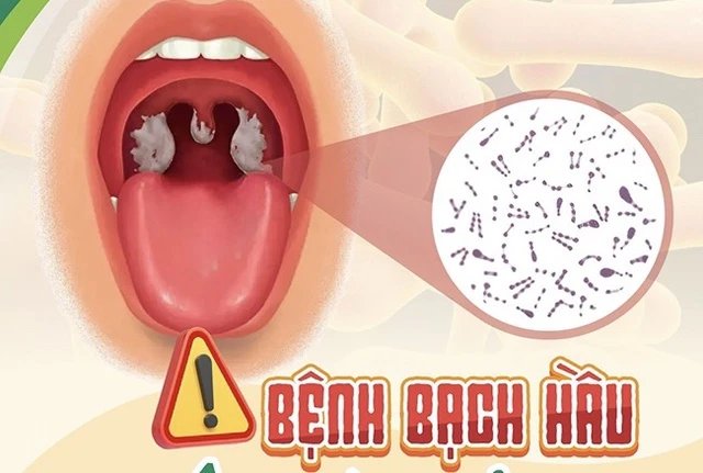 Mắc bệnh bạch hầu rồi có thể tái nhiễm không?- Ảnh 1.