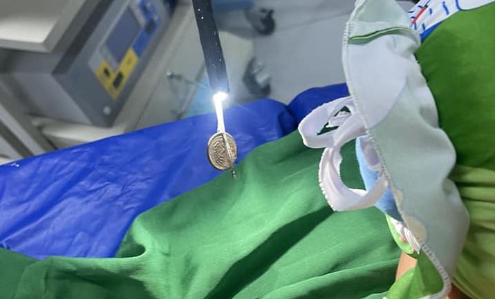 កាក់ជាប់ក្នុងពោះក្មេងប្រុសរយៈពេល 5 ថ្ងៃ - រូបថត 1. Đồng xu mắc kẹt 5 ngày trong dạ dày bé trai- Ảnh 1.