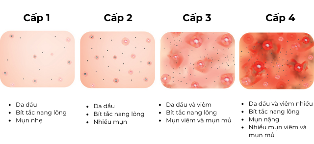 Chăm sóc da mụn thế nào để tránh tái phát?- Ảnh 3.