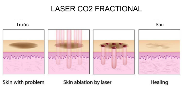 Chăm sóc da sau Laser CO2 Fractional thế nào để sẹo rỗ nhanh đầy?- Ảnh 2.