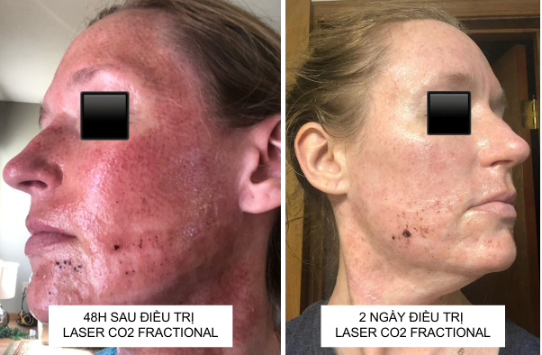 Chăm sóc da sau Laser CO2 Fractional thế nào để sẹo rỗ nhanh đầy?- Ảnh 3.