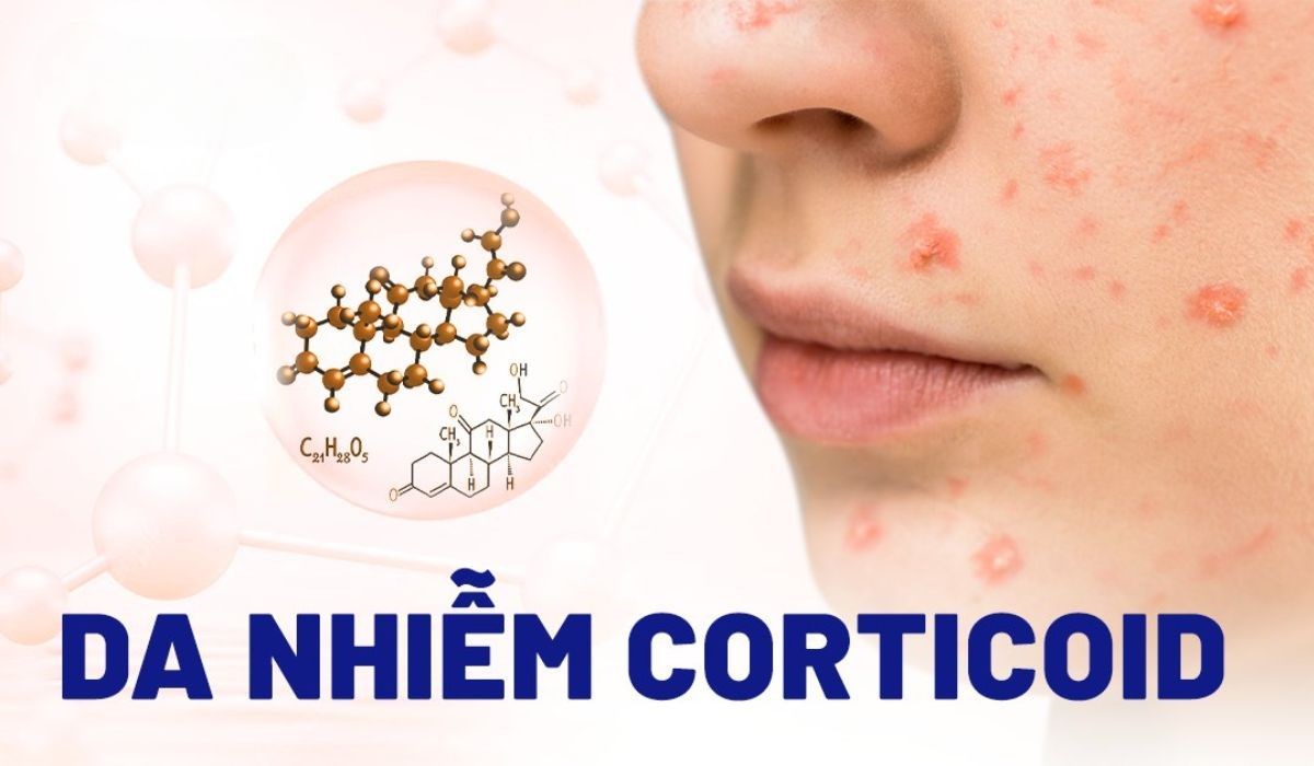 Làm thế nào để phục hồi làn da nhiễm corticoid khỏe đẹp trở lại?