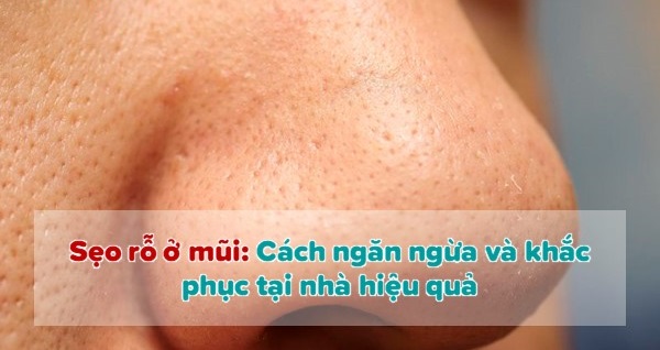 Cách trị sẹo rỗ ở mũi hiệu quả ngay tại nhà da sáng mịn thêm tự tin- Ảnh 1.