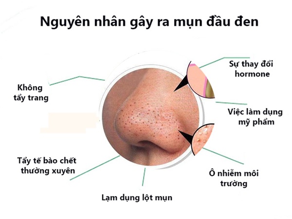 Top 3 kem trị mụn đầu đen ở mũi hiệu quả tại nhà được tìm mua nhiều- Ảnh 3.