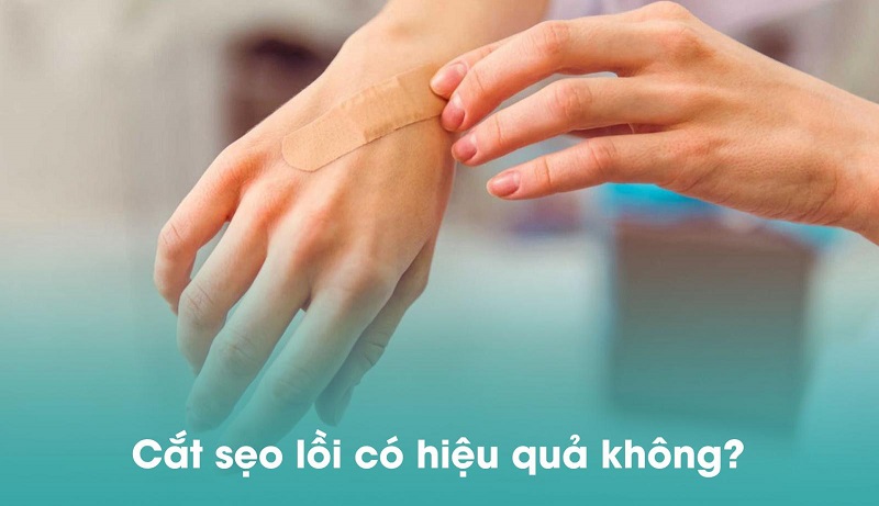 Phẫu thuật sẹo lồi có hiệu quả không? Làm thế nào để ngăn sẹo lồi tái phát?- Ảnh 1.