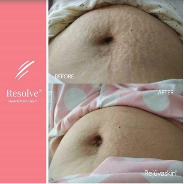 Review kem trị rạn da Rejuvaskin Stretch Mark Cream có tốt không? Mua ở đâu chính hãng?- Ảnh 3. Review kem trị rạn da Rejuvaskin Stretch Mark Cream có tốt không? Mua ở đâu chính hãng?- Ảnh 3.