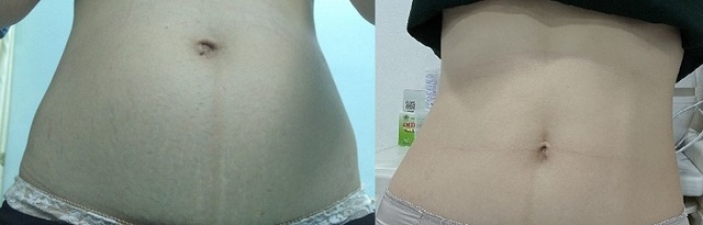 Review kem trị rạn da Rejuvaskin Stretch Mark Cream có tốt không? Mua ở đâu chính hãng?- Ảnh 8.