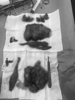 Choáng: Nam Thanh Niên Sống Cùng 2 Khối U Khổng Lồ Trên Mặt Suốt 10 Năm- Ảnh 3. Choáng: Nam Thanh Niên Sống Cùng 2 Khối U Khổng Lồ Trên Mặt Suốt 10 Năm- Ảnh 3.