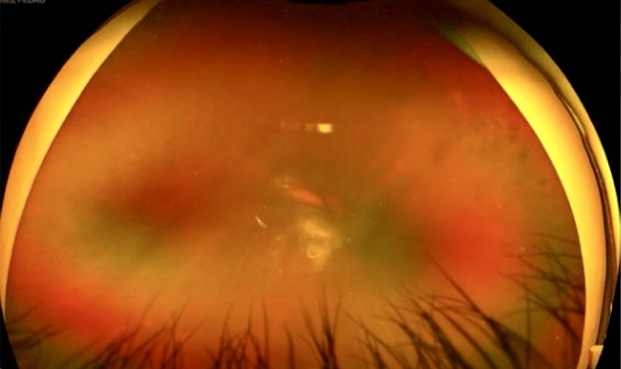 Tầm soát bệnh võng mạc miễn phí cho người bệnh đái tháo đường - Ảnh 1.