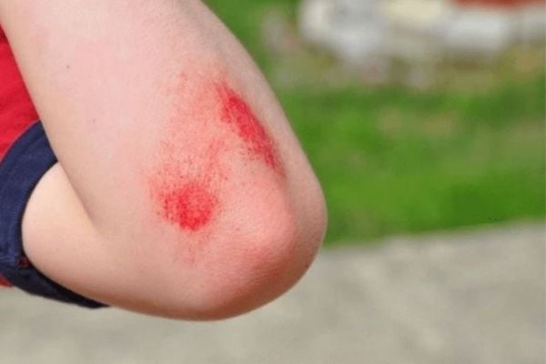 Gel b&ocirc;i vết thương hở n&agrave;o mau l&agrave;nh, hạn chế sẹo tối đa? - Ảnh 2.