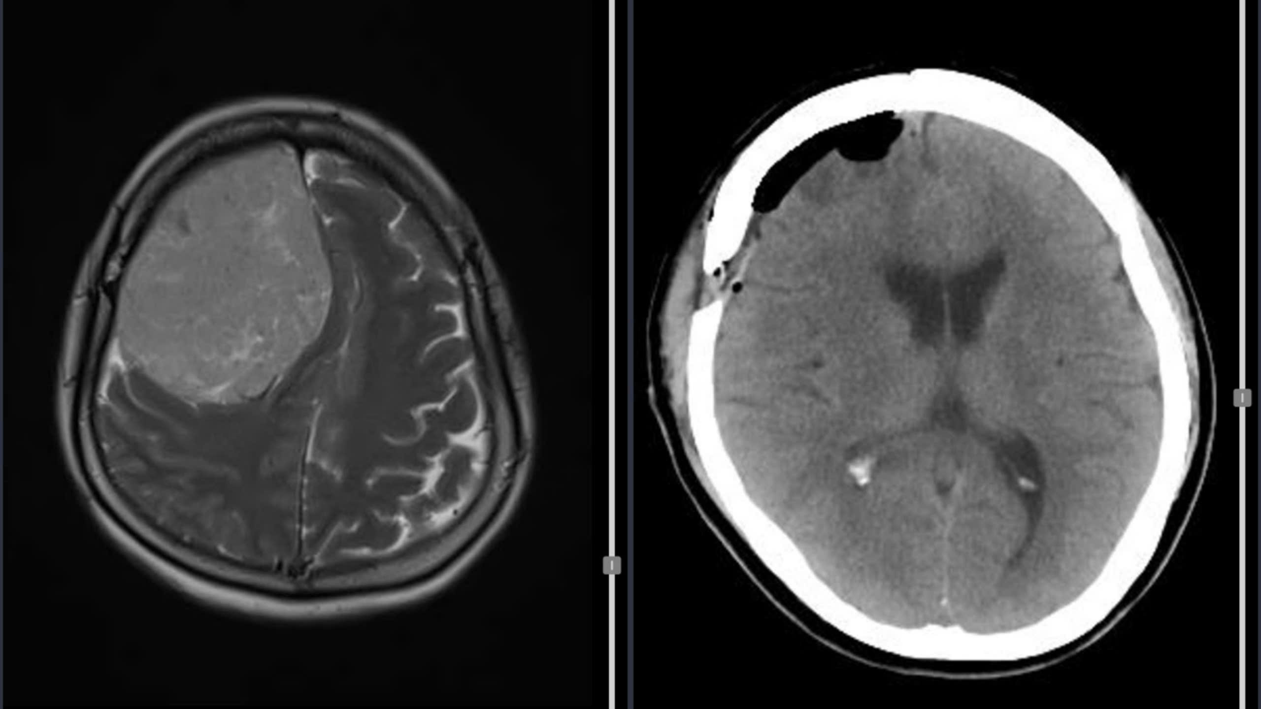 Đau đầu, yếu nửa người, khám bệnh phát hiện khối u màng não nặng 600 gram - Ảnh 1.