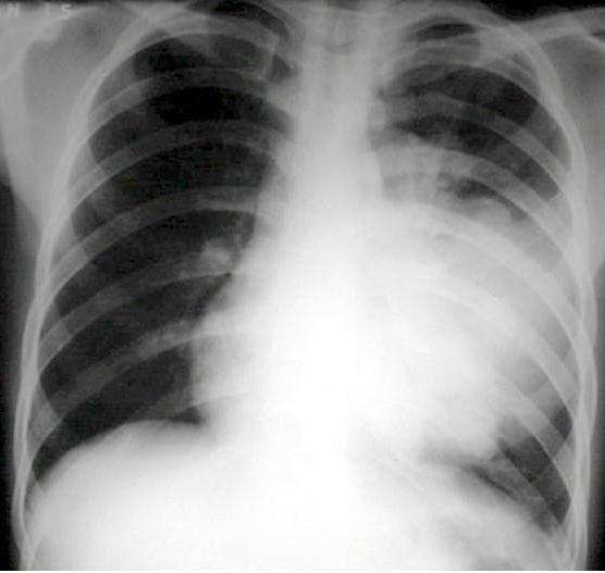 Cảnh báo về vi khuẩn trong hơi thở dễ làm lây lan bệnh hô hấp - Ảnh 1.