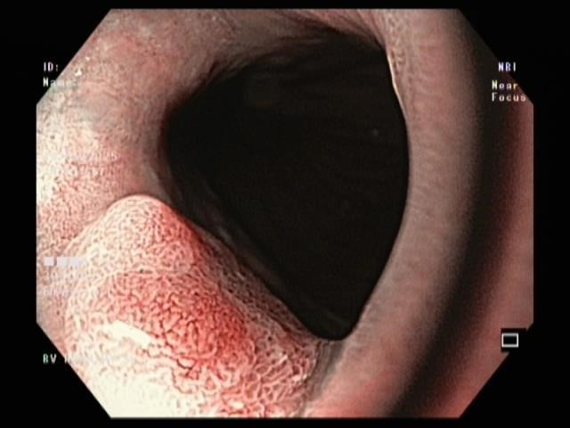 Cắt Tách Dưới Niêm Mạc Qua Nội Soi, Giải Pháp Loại Bỏ Khối U Tiêu Hóa - Ảnh 1.