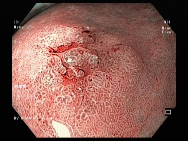 Cắt Tách Dưới Niêm Mạc Qua Nội Soi, Giải Pháp Loại Bỏ Khối U Tiêu Hóa - Ảnh 2.