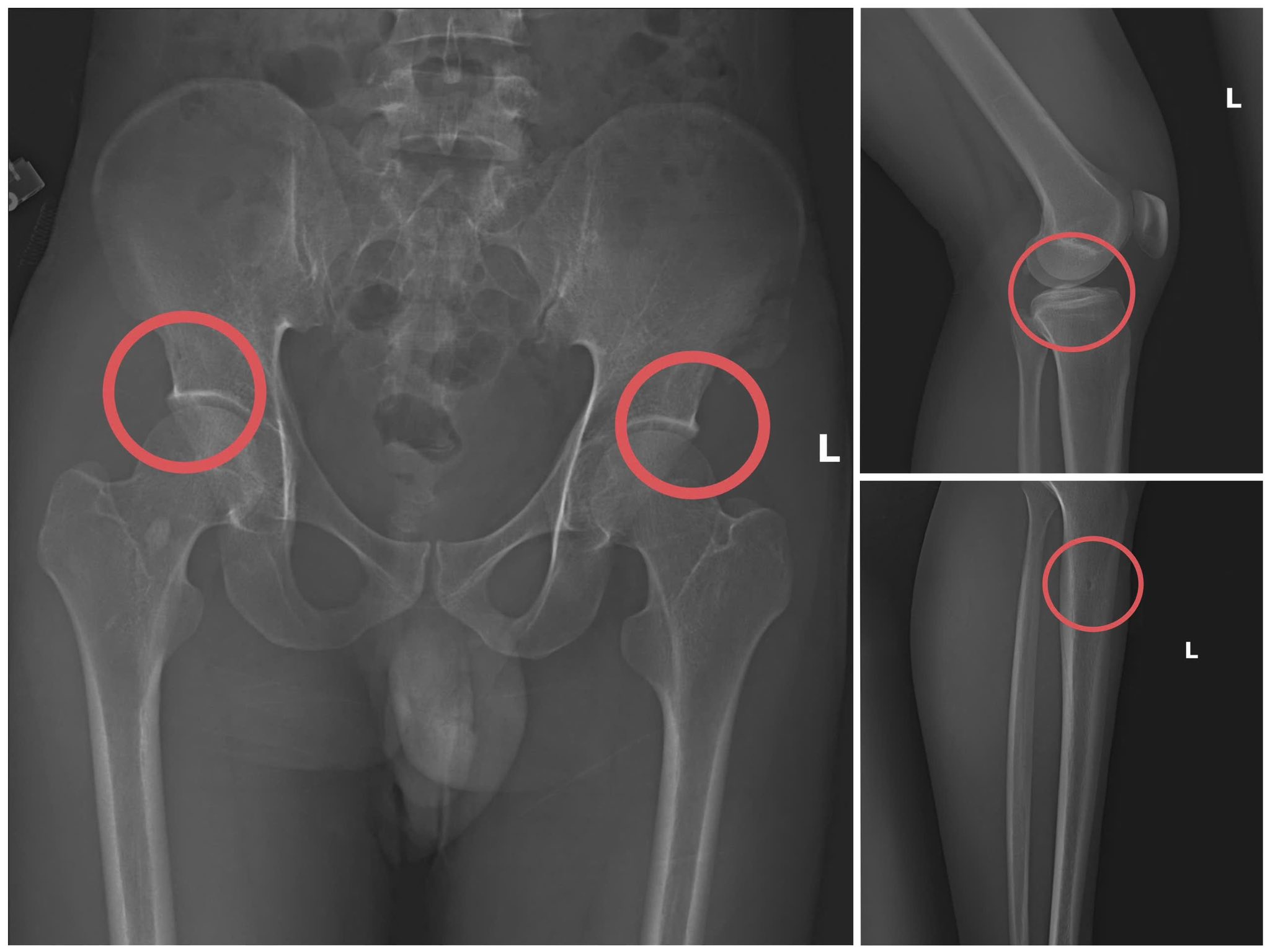 Tự đục vỡ xương, gây thương tích giả để lừa 6 tỉ của bảo hiểm nhân thọ - Ảnh 2.