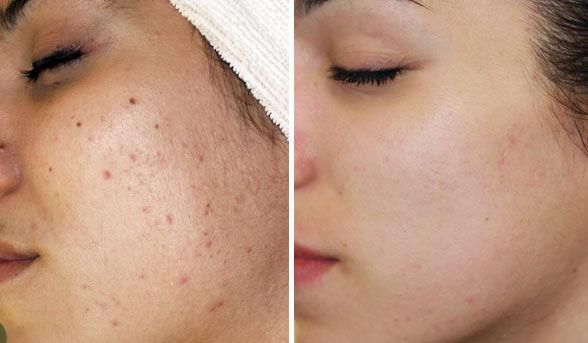 V&igrave; sao Scar Esthetique l&agrave; sản phẩm d&agrave;nh cho th&acirc;m đỏ sau mụn? - Ảnh 2.