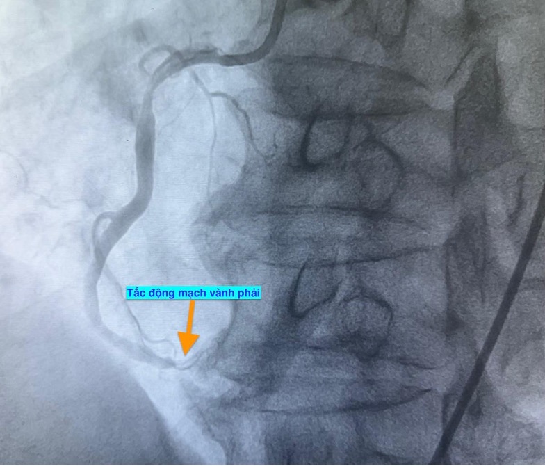 1 ngày 4 ca nhồi máu cơ tim cấp nhập viện, có bất thường?- Ảnh 1. 1 ngày 4 ca nhồi máu cơ tim cấp nhập viện, có bất thường?- Ảnh 1.
