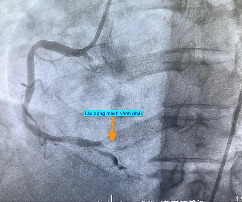 1 ngày 4 ca nhồi máu cơ tim cấp nhập viện, có bất thường?- Ảnh 2. 1 ngày 4 ca nhồi máu cơ tim cấp nhập viện, có bất thường?- Ảnh 2.