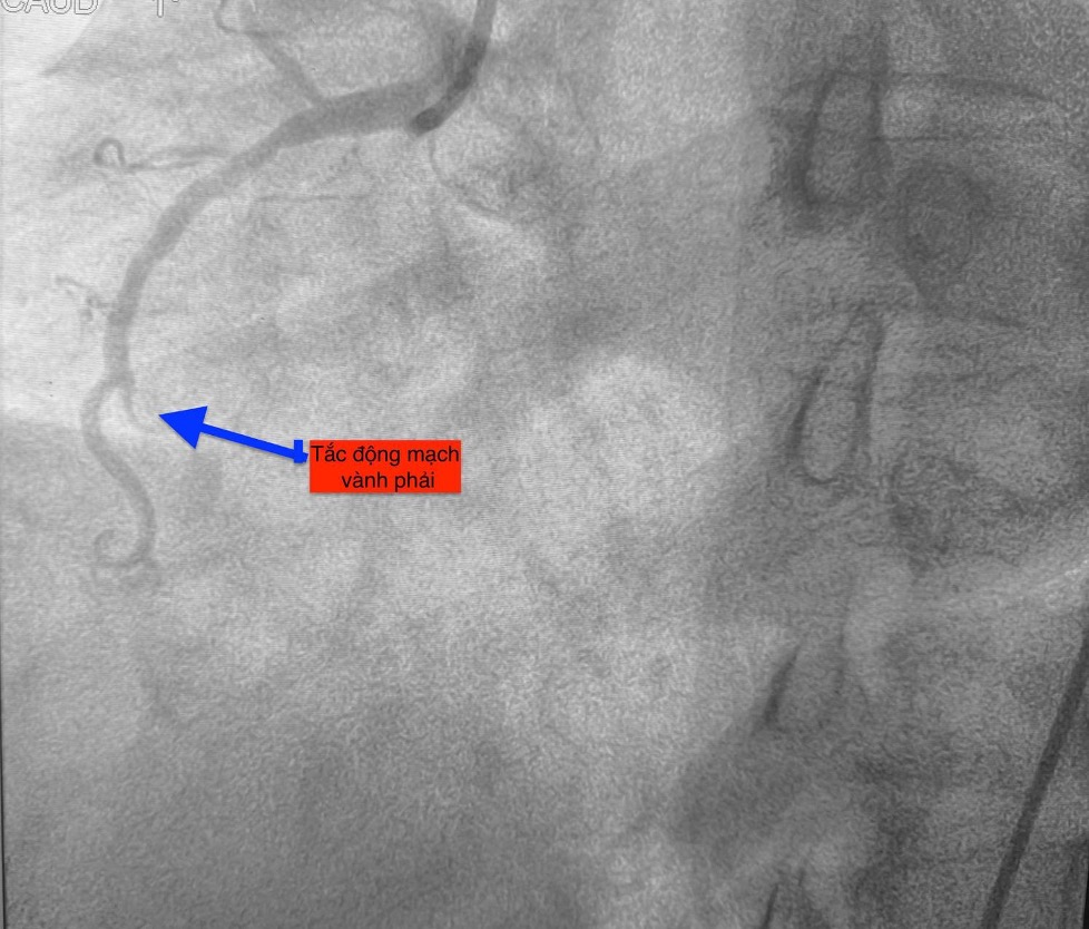 1 ngày 4 ca nhồi máu cơ tim cấp nhập viện, có bất thường?- Ảnh 3. 1 ngày 4 ca nhồi máu cơ tim cấp nhập viện, có bất thường?- Ảnh 3.