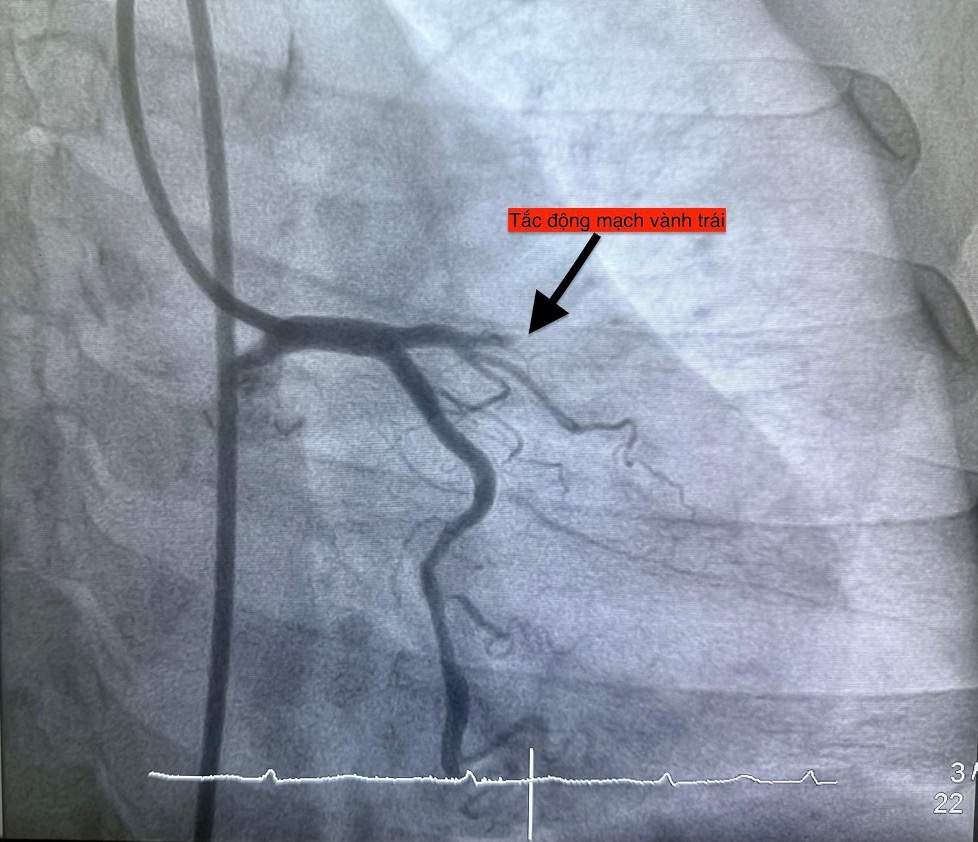 1 ngày 4 ca nhồi máu cơ tim cấp nhập viện, có bất thường?- Ảnh 4. 1 ngày 4 ca nhồi máu cơ tim cấp nhập viện, có bất thường?- Ảnh 4.