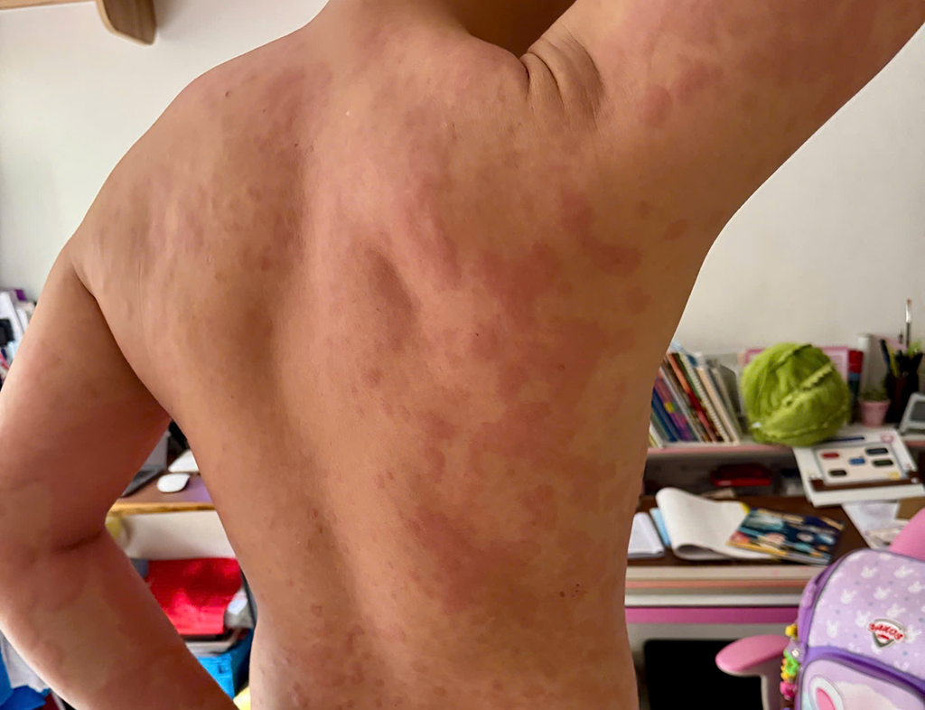 Bác sĩ 24/7: Nổi mề đay ngứa ngáy khó chịu, có cần xét nghiệm tìm nguyên nhân? - Ảnh 1.