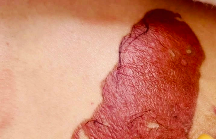 Dán cao trị u vú, đi khám phát hiện ung thư - Ảnh 1.