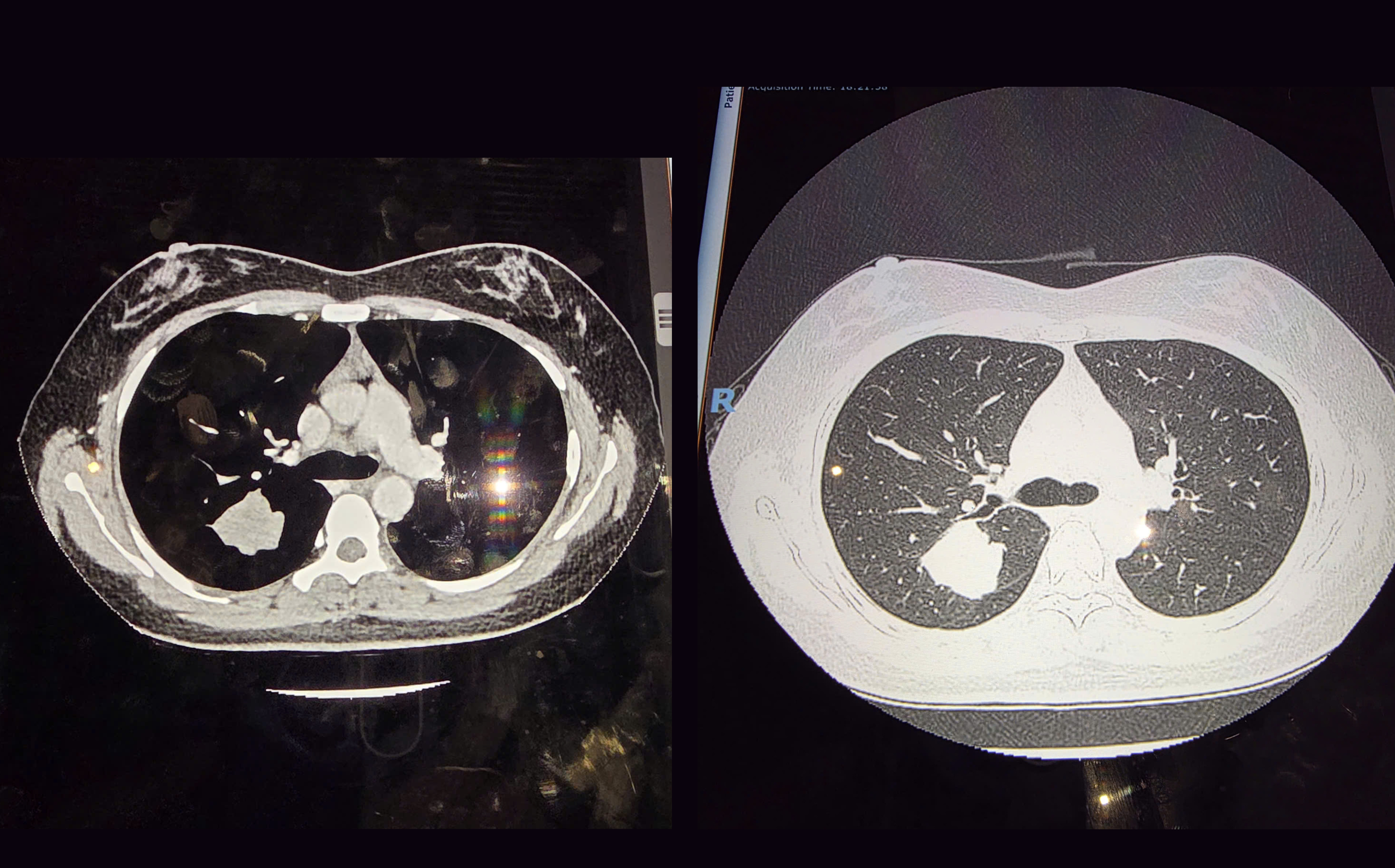 Tình cờ phát hiện ung thư phổi nhờ khám sức khỏe định kỳ - Ảnh 1.