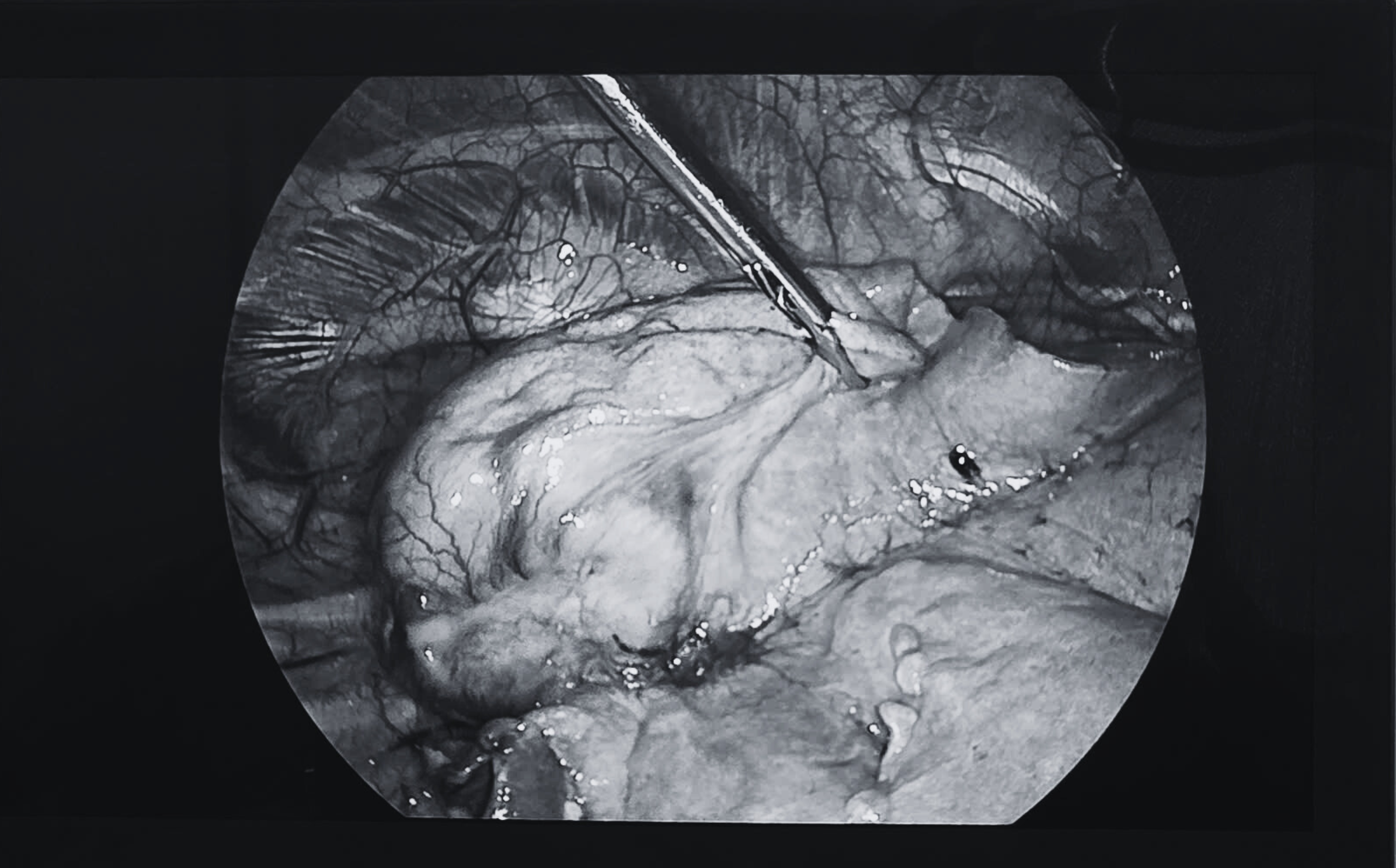 Tình cờ phát hiện ung thư phổi nhờ khám sức khỏe định kỳ - Ảnh 2.
