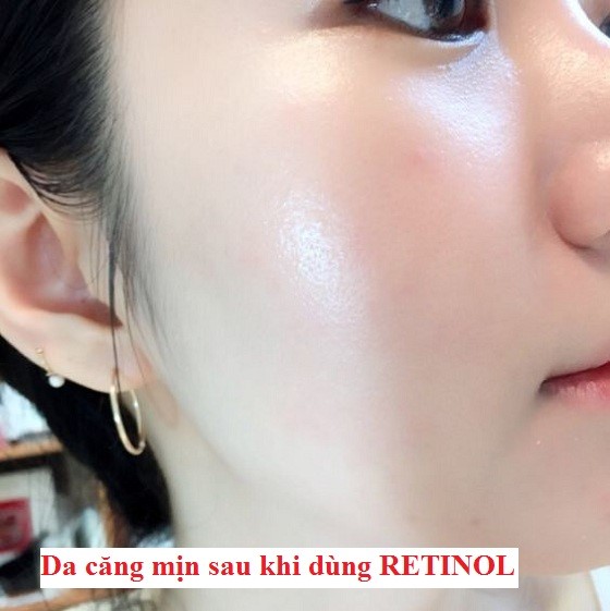 Top 3 kem Retinol êm dịu mà cải thiện nếp nhăn cực đỉnh, muốn già cũng khó- Ảnh 1. Top 3 kem Retinol êm dịu mà cải thiện nếp nhăn cực đỉnh, muốn già cũng khó- Ảnh 1.
